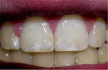 フッ素塗布は歯に良いのか、悪そうだ